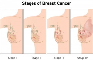 Breast density: over 700,000 UK women living with ‘hidden’ breast cancer risk