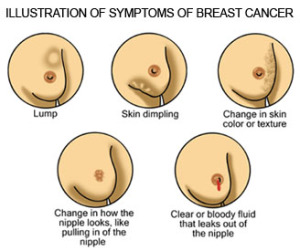 breast-cancer-symptoms-pictures-nipple-how-to-understand-the-symptoms-of-breast-cancer-therascope-pzsgqscf