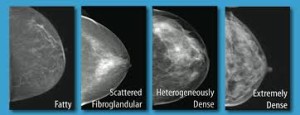dense-breasts