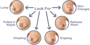 Signs-of-Breast-Cancer